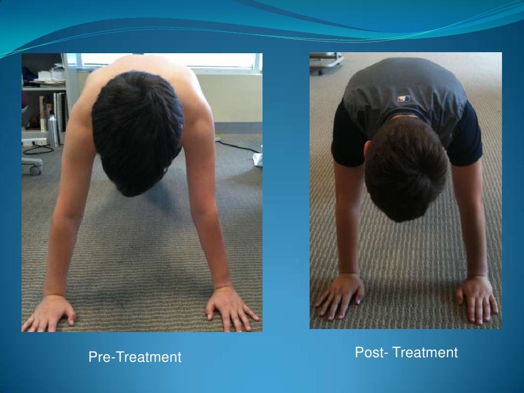 Wrist Injuries In Gymnast