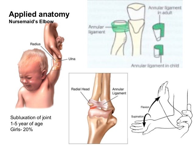 Applied anatomy
Nursemaid’s Elbow
Subluxation of joint
1-5 year of age
Girls- 20%