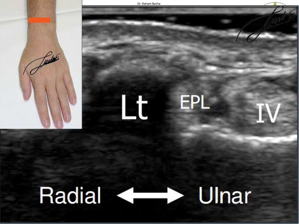 Wrist joint ultrasound