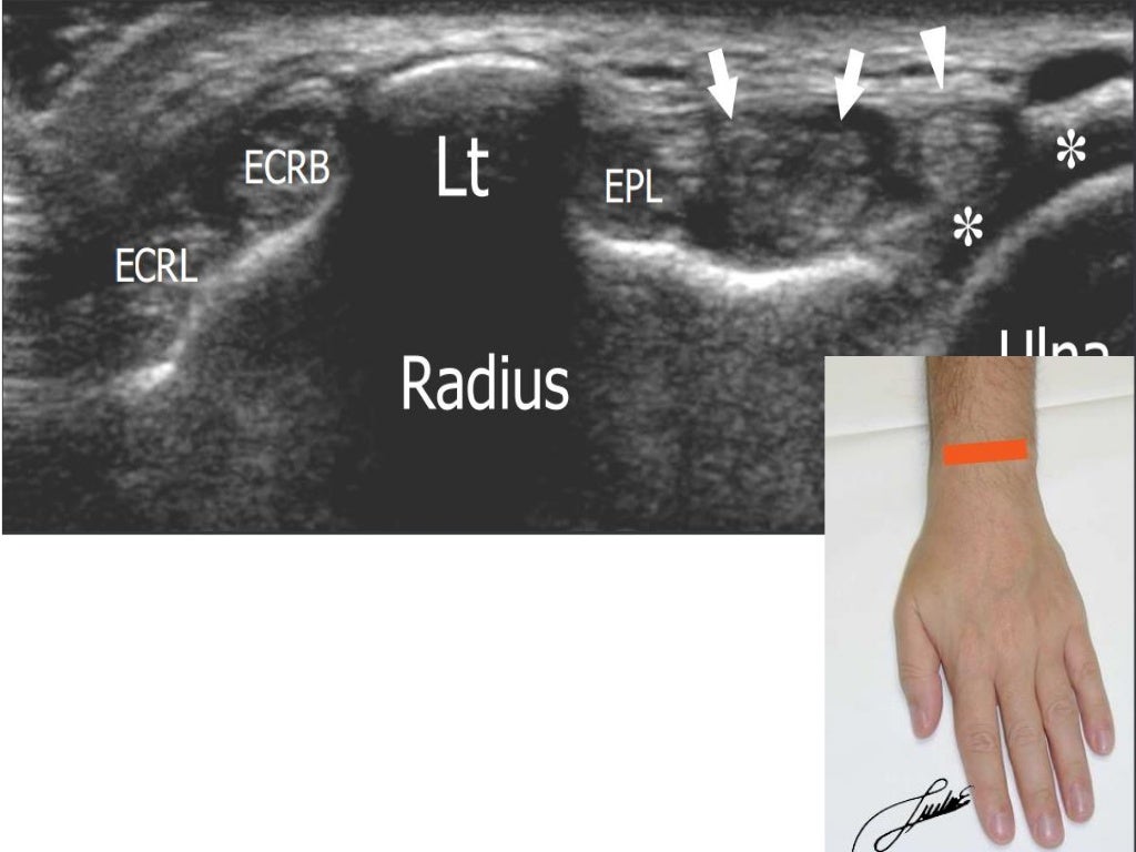 Wrist joint ultrasound