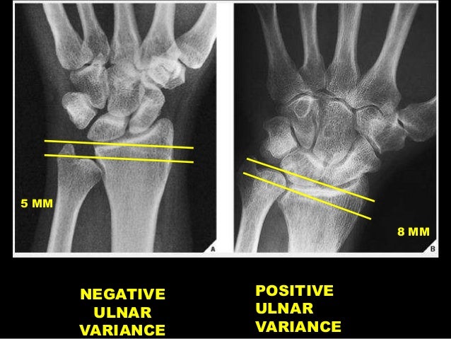 Ulna Minus Oder Plus Variante Oss re Normvarianten In Der Ulna Minus Oder Plus Variante Oss re Normvarianten In Der