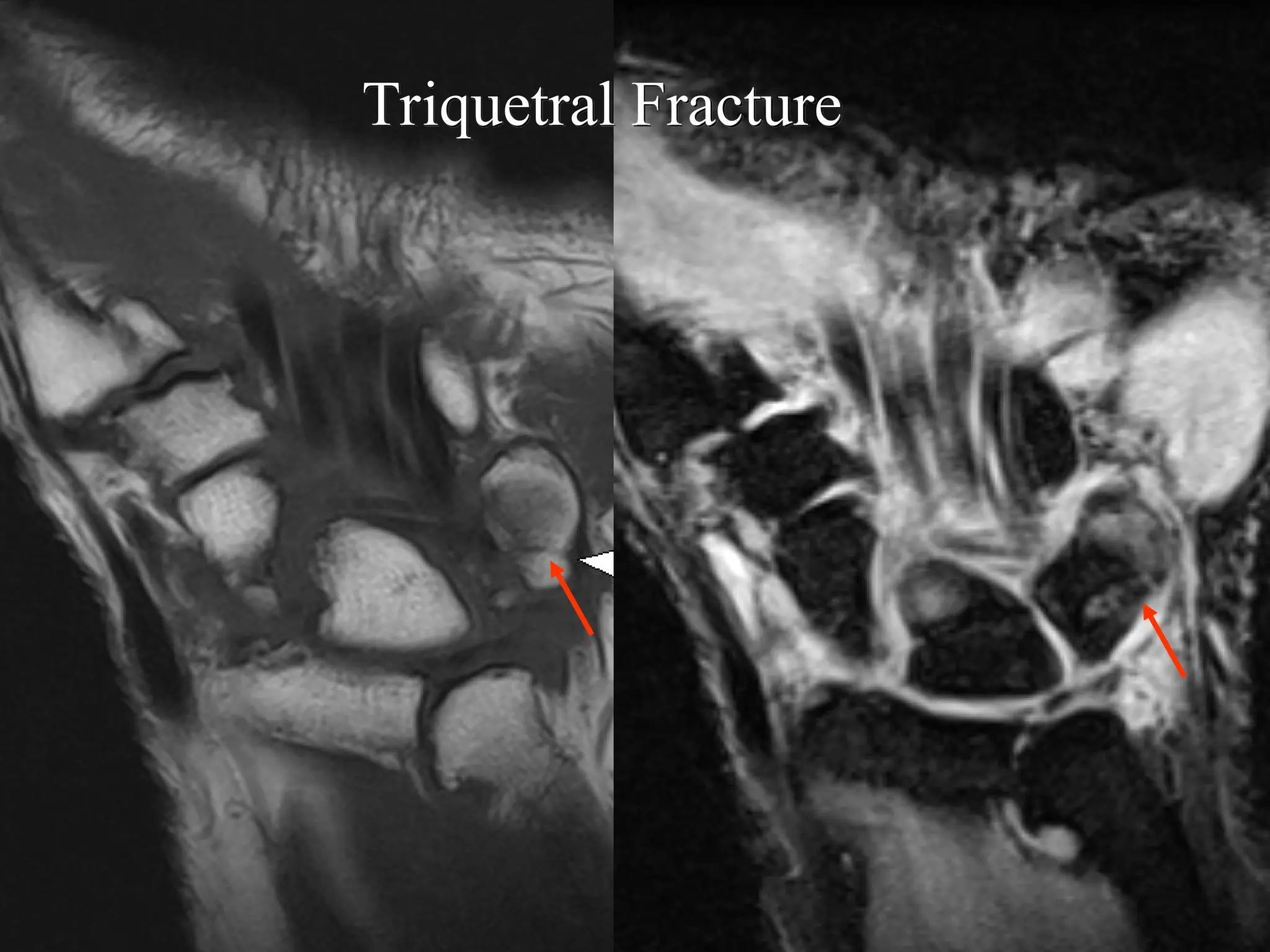 Wrist MRI Magnetic Resonance Imaging.ppt