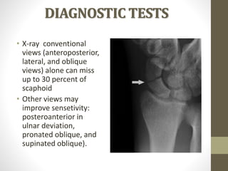 DIAGNOSTIC TESTS
• X-ray conventional
views (anteroposterior,
lateral, and oblique
views) alone can miss
up to 30 percent of
scaphoid
• Other views may
improve sensetivity:
posteroanterior in
ulnar deviation,
pronated oblique, and
supinated oblique).
 