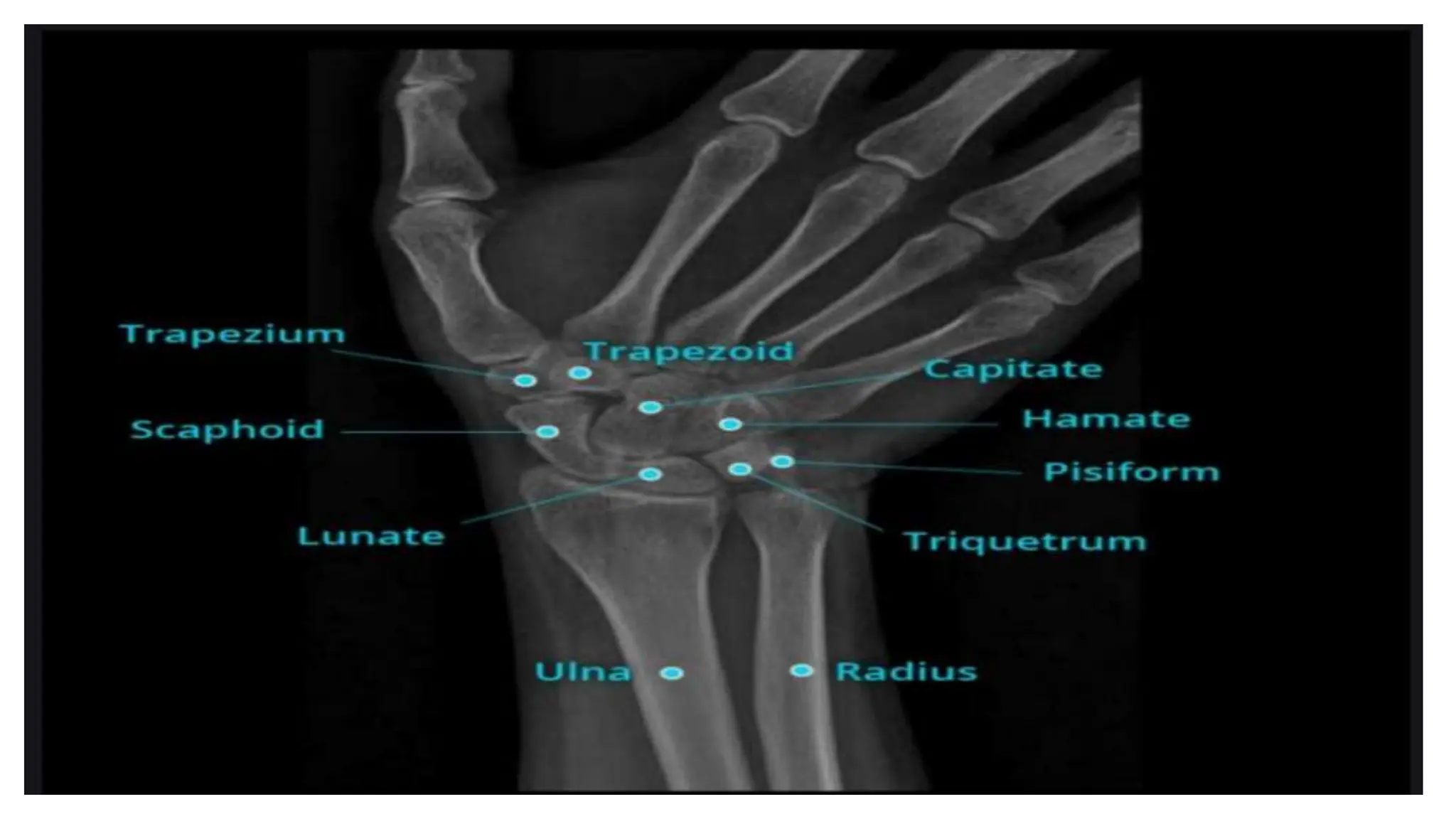 WRIST RADIOGRAPHY , Bathmahariswaran (1).pptx
