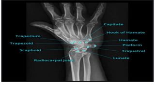 WRIST RADIOGRAPHY , Bathmahariswaran (1).pptx