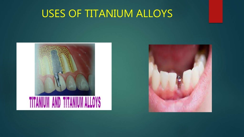 Wrought alloys in dentistry