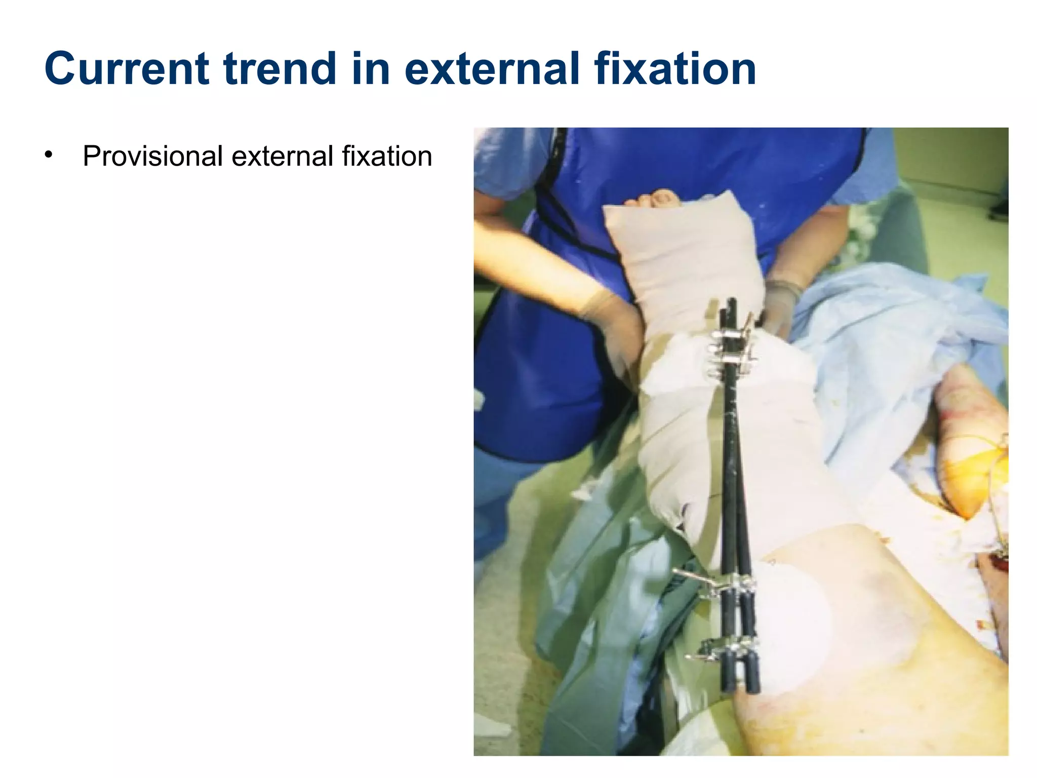Current trend in external fixation
• Provisional external fixation
 