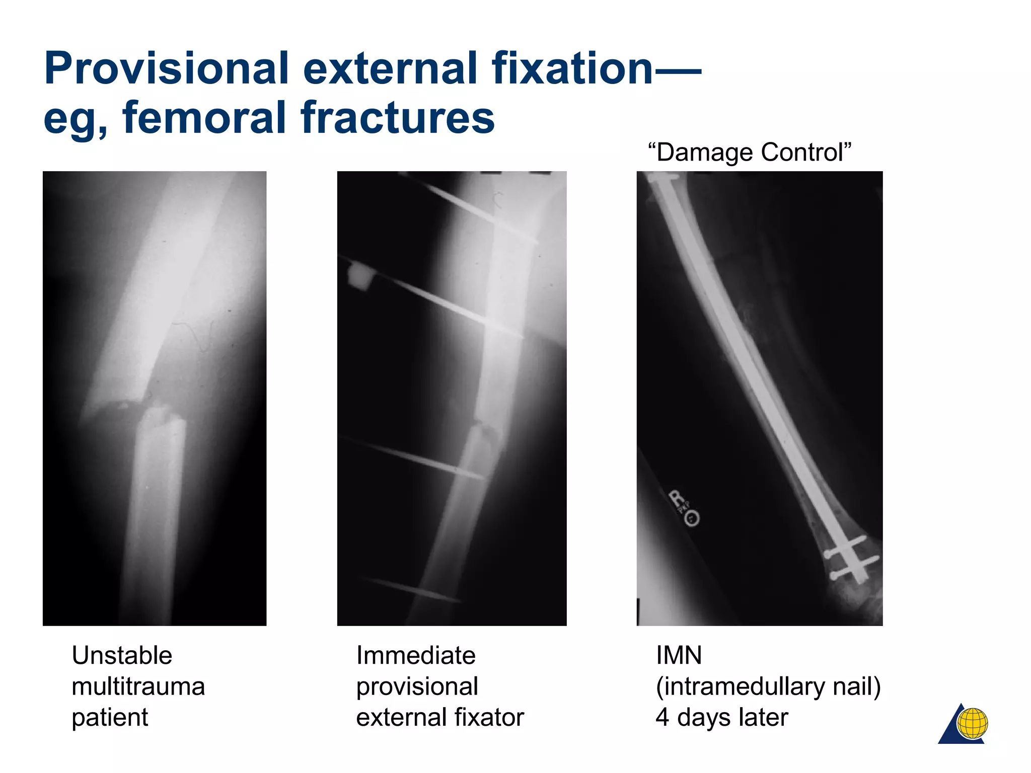 Provisional external fixation—
eg, femoral fractures
IMN
(intramedullary nail)
4 days later
Unstable
multitrauma
patient
Immediate
provisional
external fixator
“Damage Control”
 