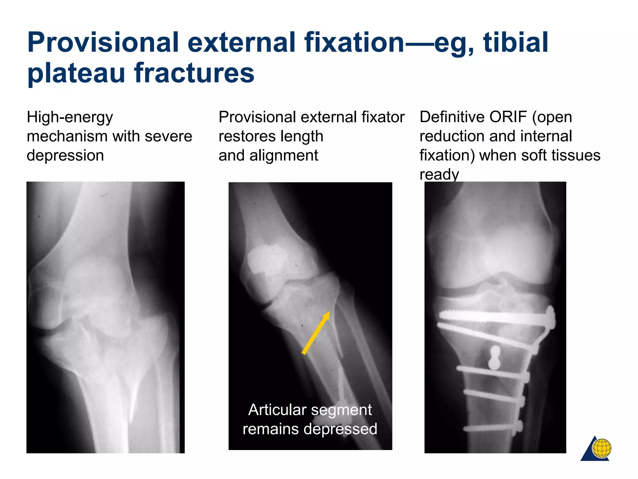 High-energy
mechanism with severe
depression
Provisional external fixation—eg, tibial
plateau fractures
Provisional external fixator
restores length
and alignment
Definitive ORIF (open
reduction and internal
fixation) when soft tissues
ready
Articular segment
remains depressed
 