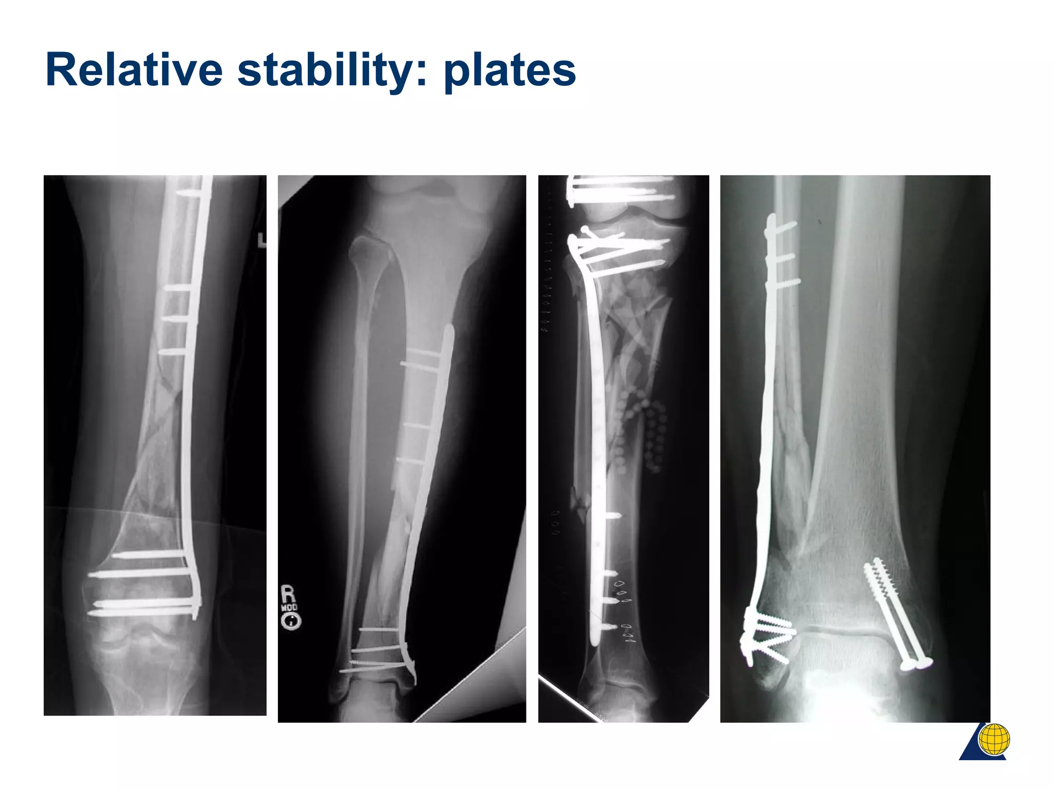 Relative stability: plates
 