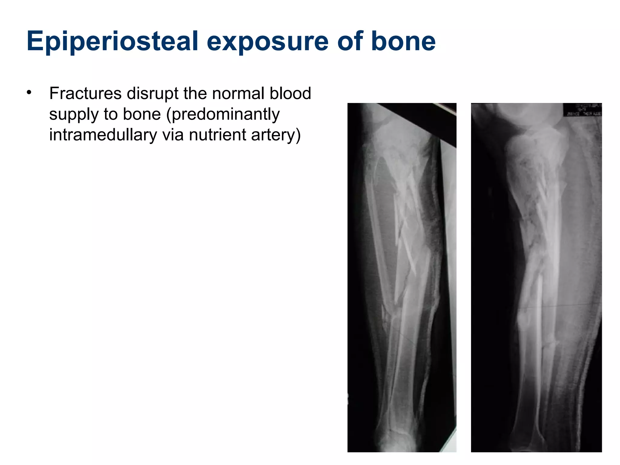Epiperiosteal exposure of bone
• Fractures disrupt the normal blood
supply to bone (predominantly
intramedullary via nutrient artery)
 