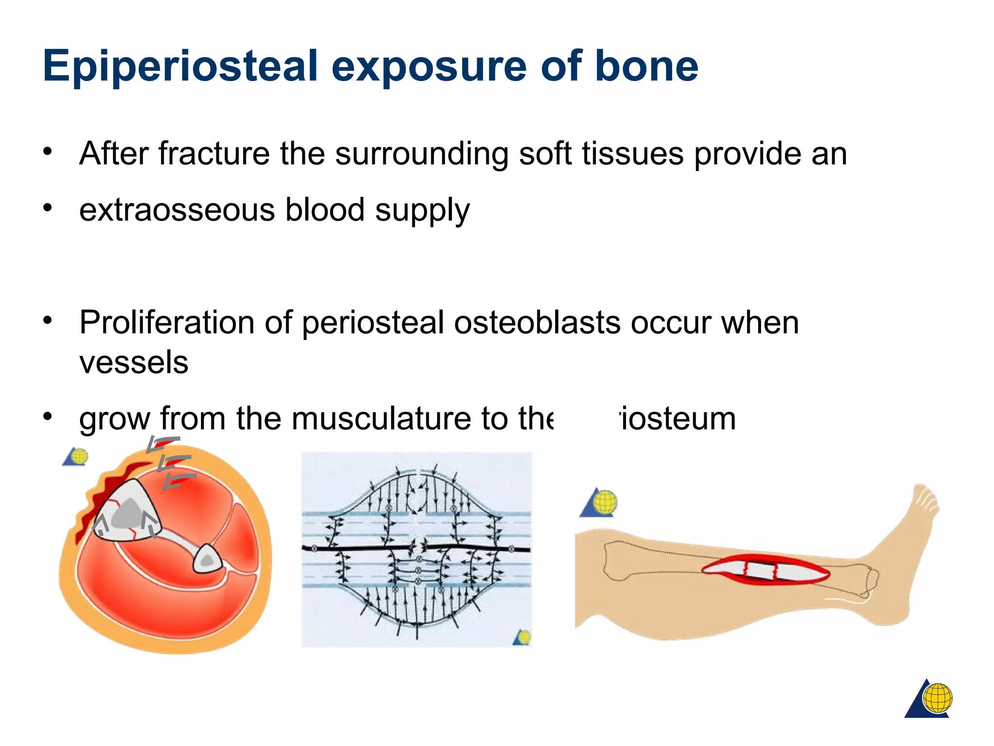 Epiperiosteal exposure of bone
• After fracture the surrounding soft tissues provide an
• extraosseous blood supply
• Proliferation of periosteal osteoblasts occur when
vessels
• grow from the musculature to the periosteum
 