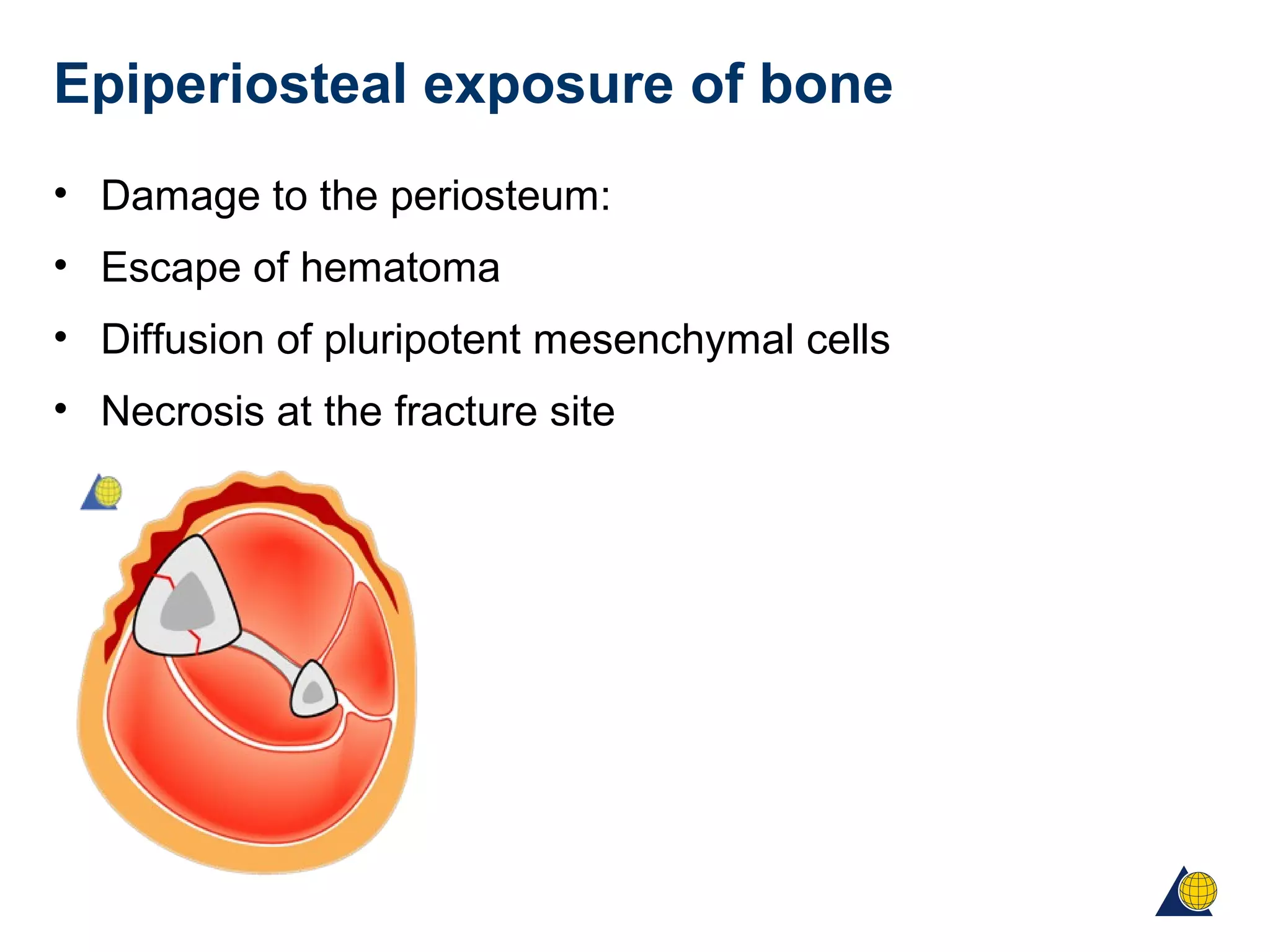 Epiperiosteal exposure of bone
• Damage to the periosteum:
• Escape of hematoma
• Diffusion of pluripotent mesenchymal cells
• Necrosis at the fracture site
 