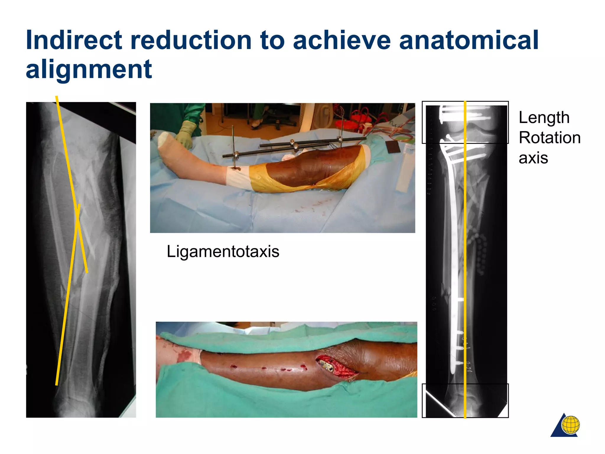 Indirect reduction to achieve anatomical
alignment
Ligamentotaxis
Length
Rotation
axis
 