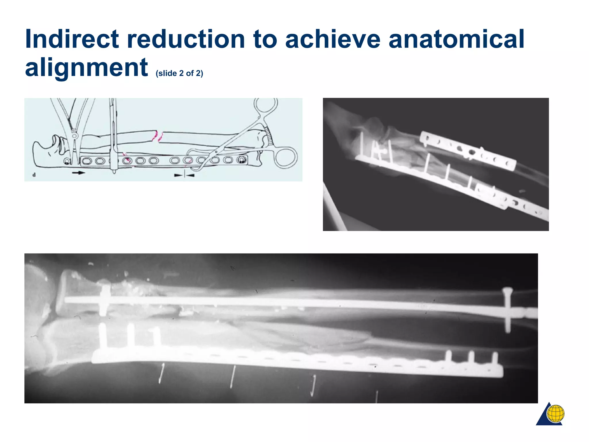 Indirect reduction to achieve anatomical
alignment (slide 2 of 2)
 