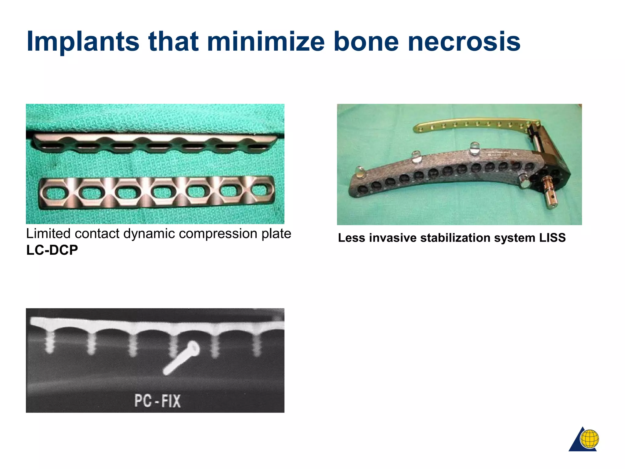 Implants that minimize bone necrosis
Limited contact dynamic compression plate
LC-DCP
Less invasive stabilization system LISS
 