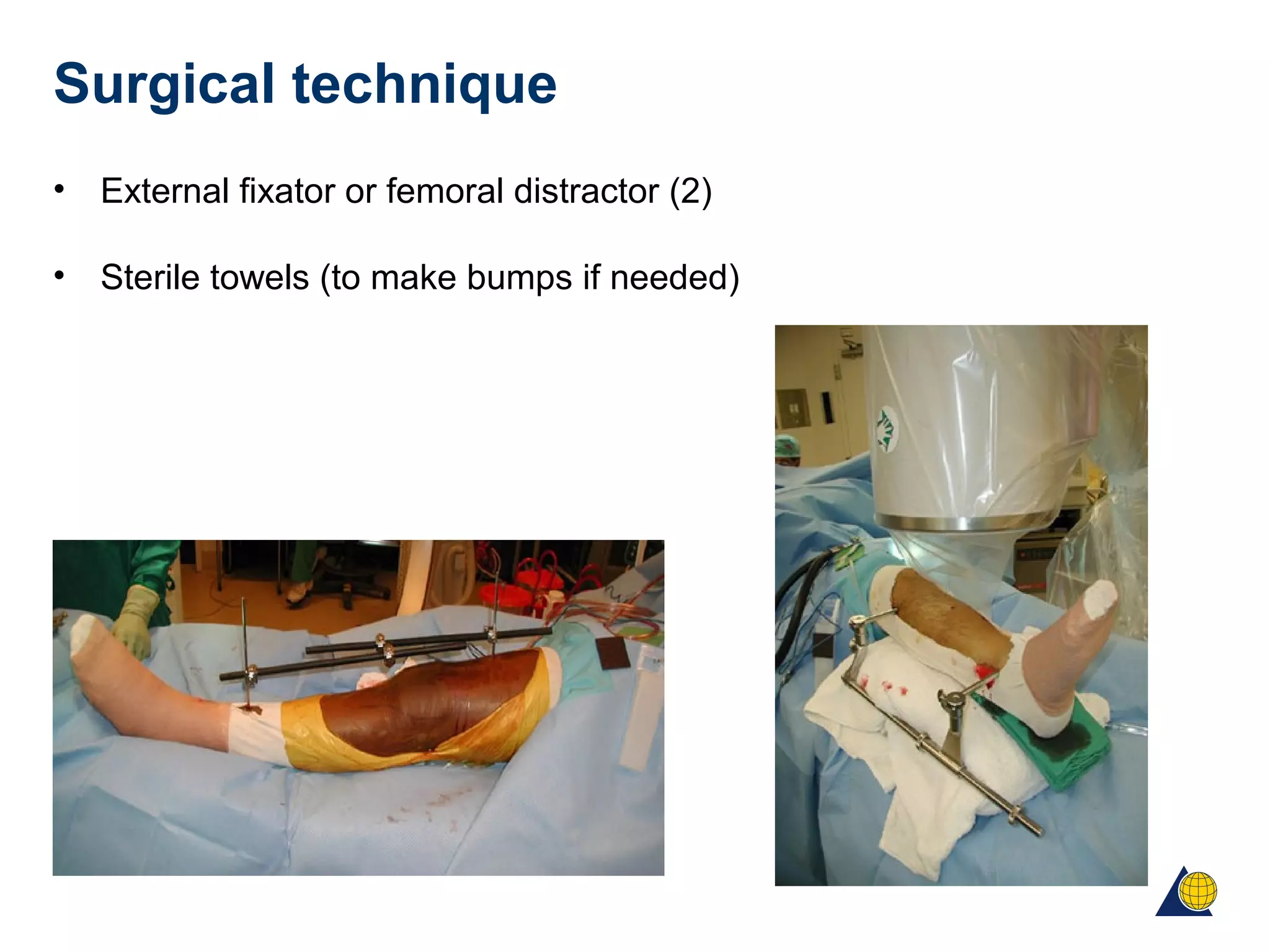 Surgical technique
• External fixator or femoral distractor (2)
• Sterile towels (to make bumps if needed)
 