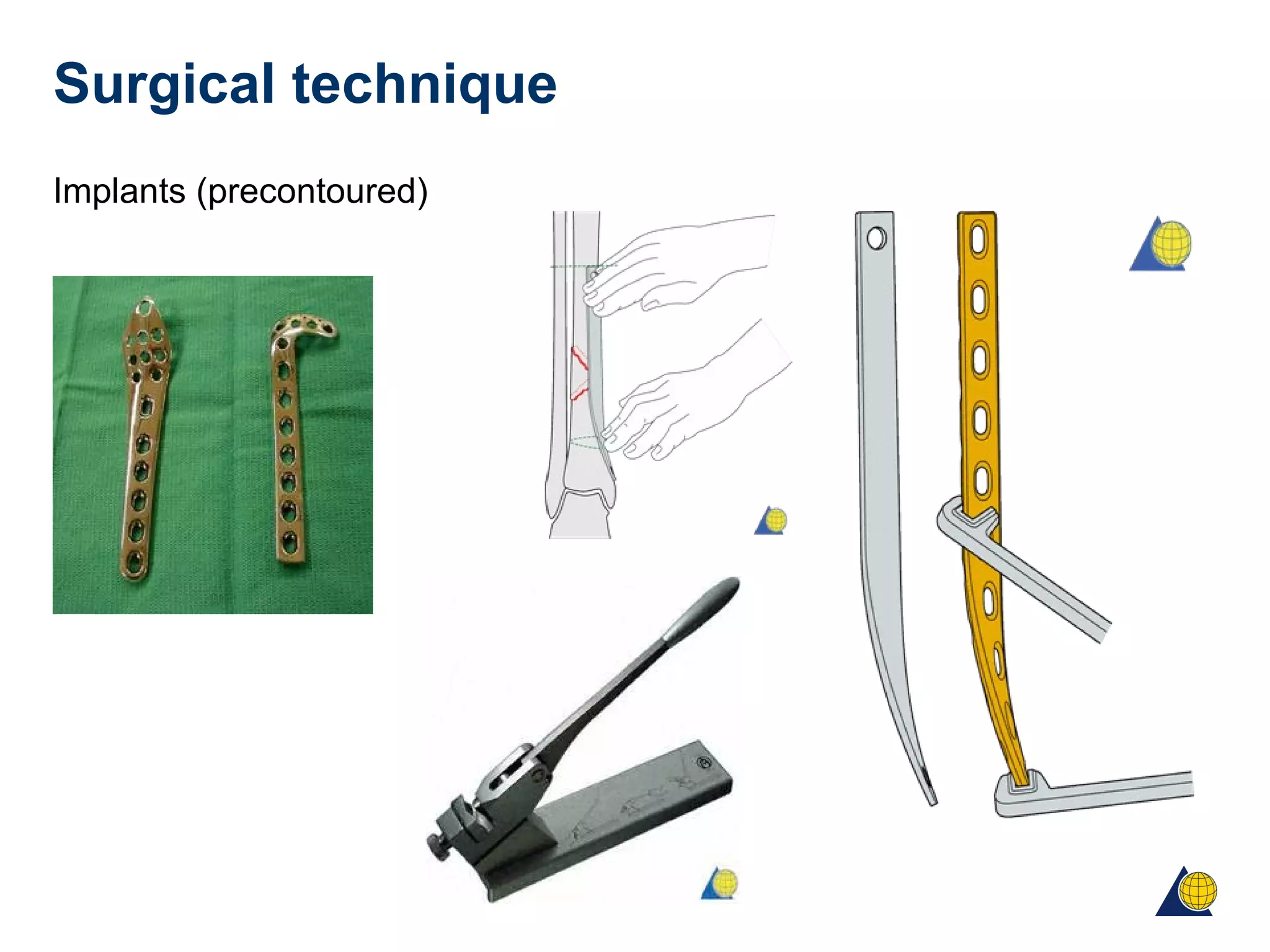 Surgical technique
Implants (precontoured)
 