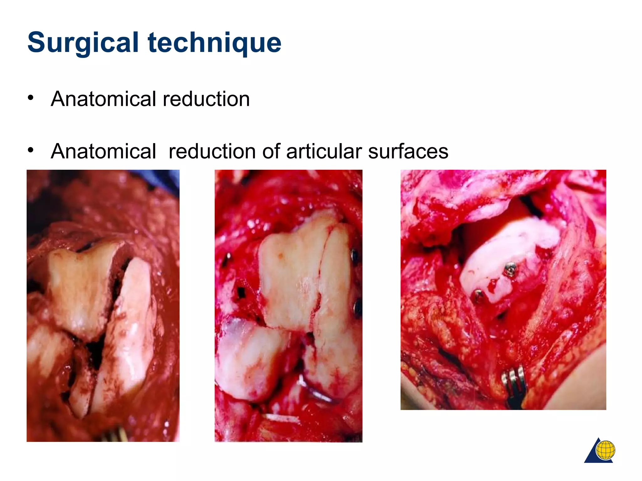 Surgical technique
• Anatomical reduction
• Anatomical reduction of articular surfaces
 