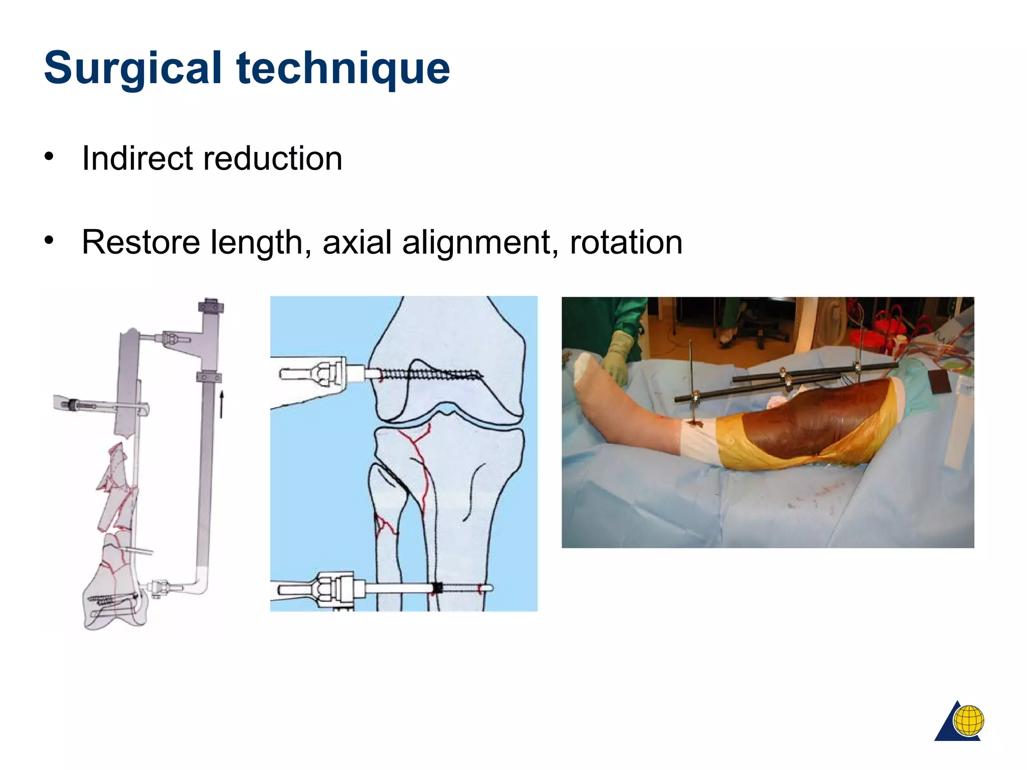 Surgical technique
• Indirect reduction
• Restore length, axial alignment, rotation
 