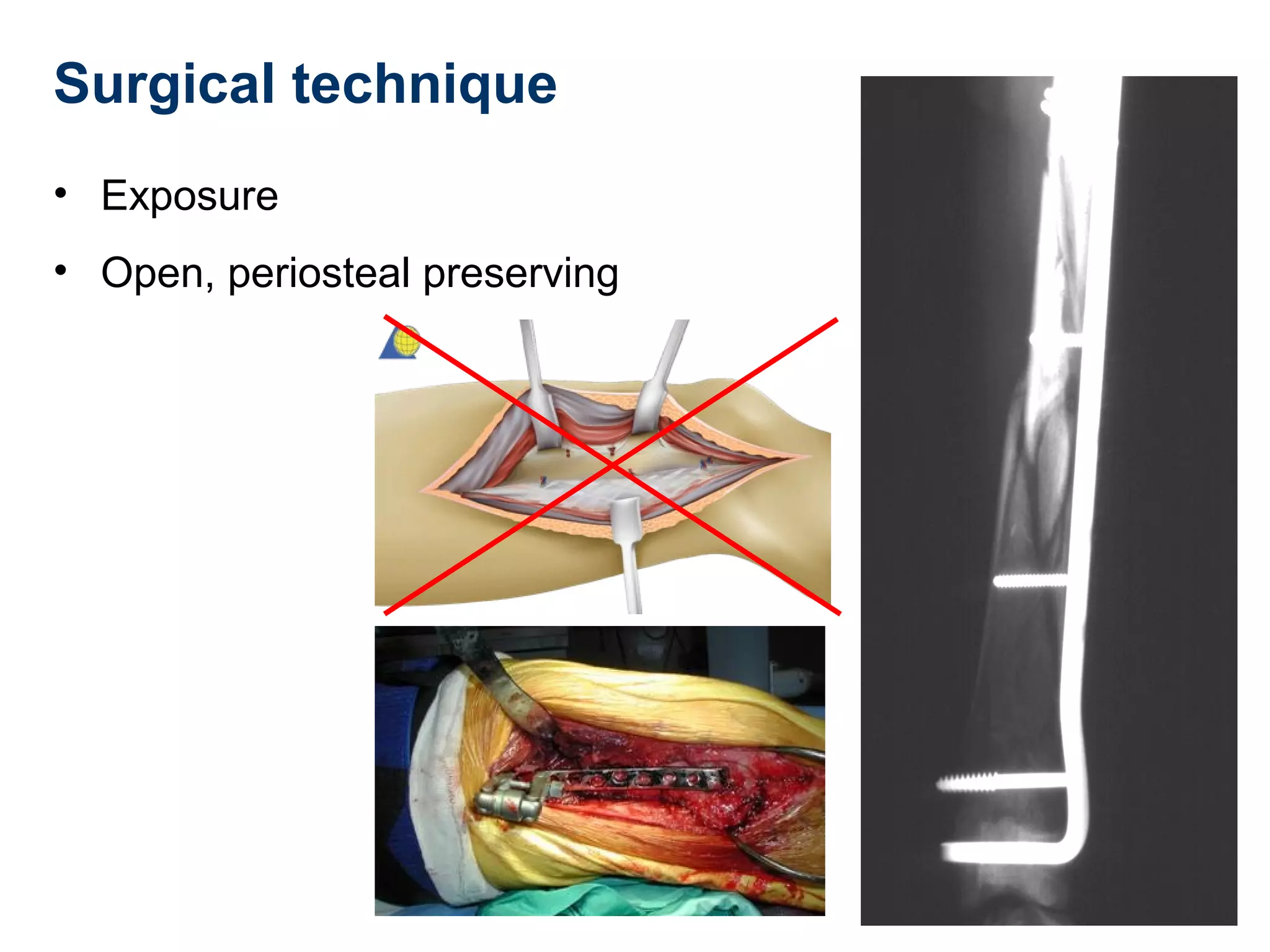 Surgical technique
• Exposure
• Open, periosteal preserving
 