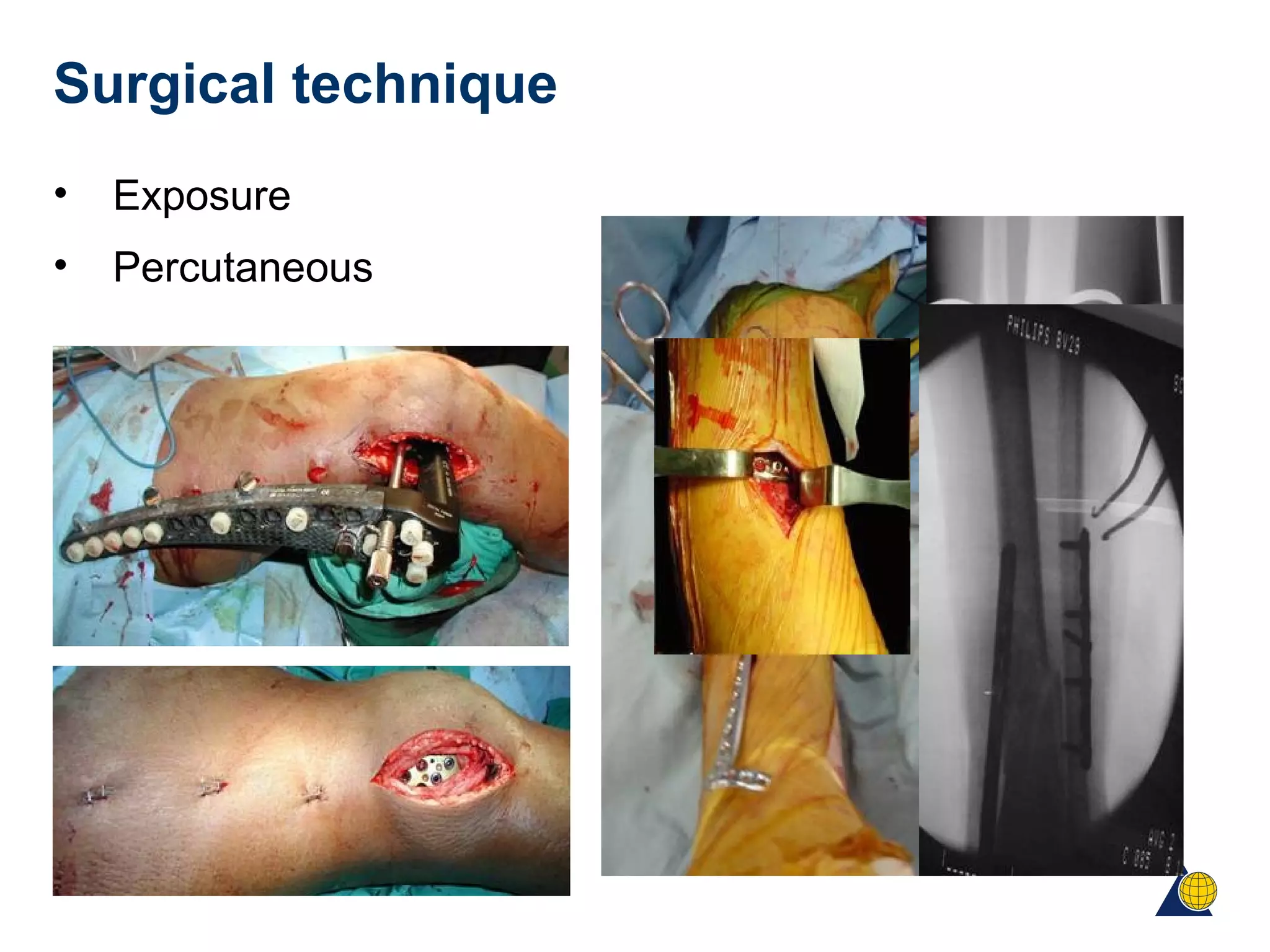 Surgical technique
• Exposure
• Percutaneous
 