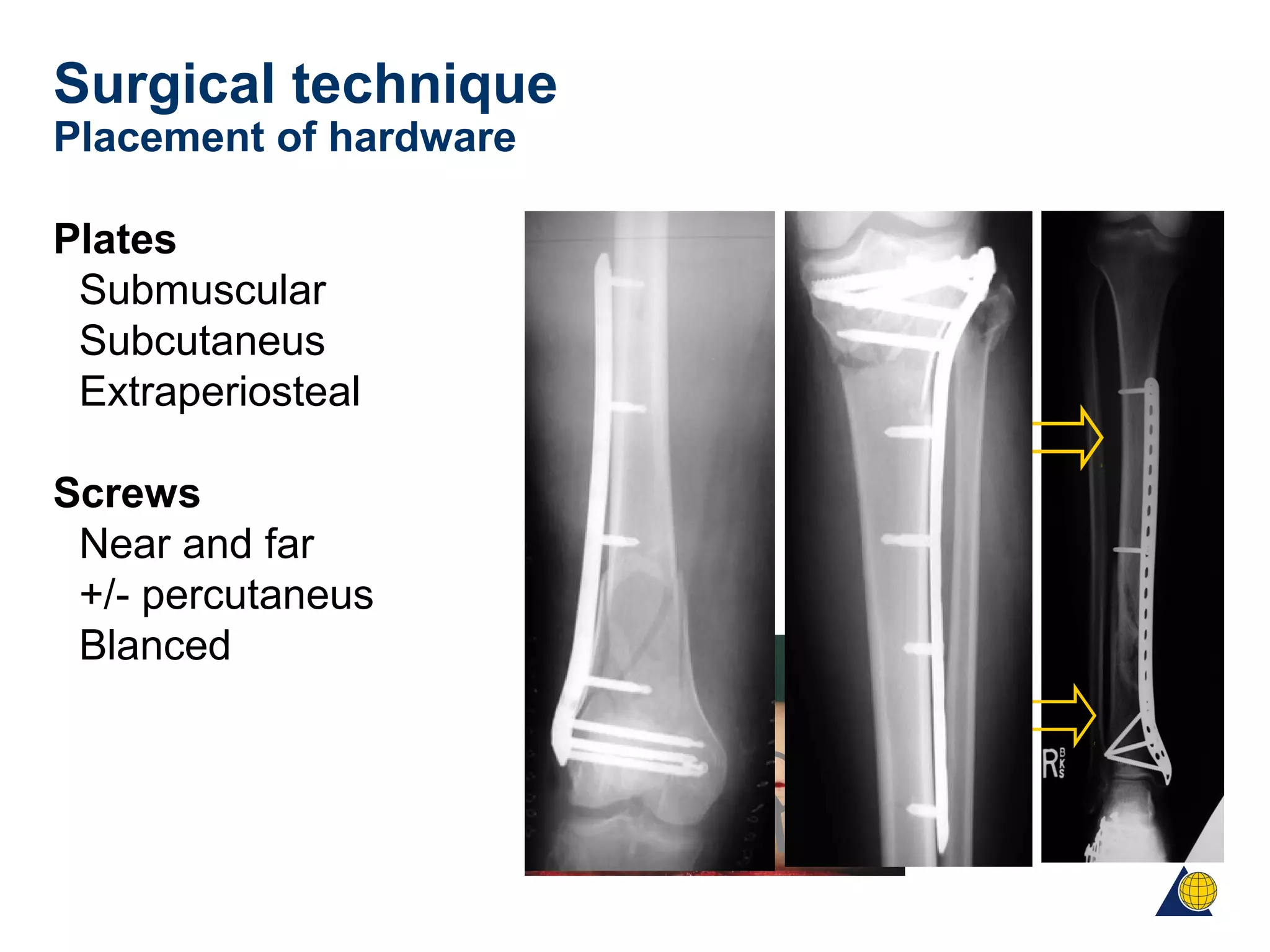 Surgical technique
Placement of hardware
Plates
Submuscular
Subcutaneus
Extraperiosteal
Screws
Near and far
+/- percutaneus
Blanced
 