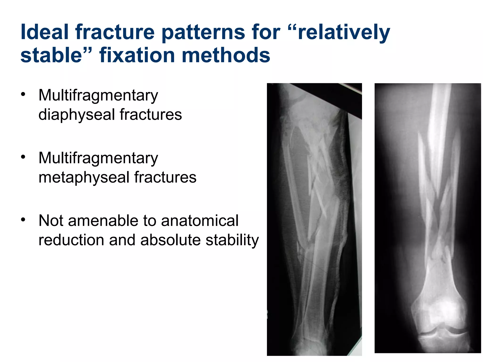 Ideal fracture patterns for “relatively
stable” fixation methods
• Multifragmentary
diaphyseal fractures
• Multifragmentary
metaphyseal fractures
• Not amenable to anatomical
reduction and absolute stability
 
