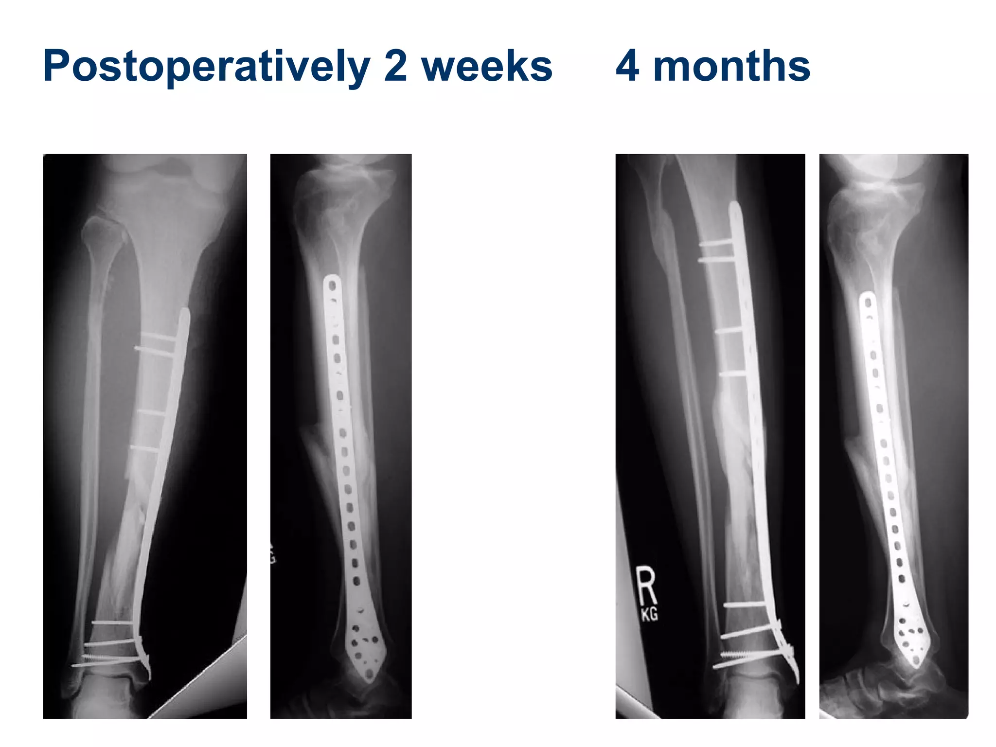 Postoperatively 2 weeks 4 months
 