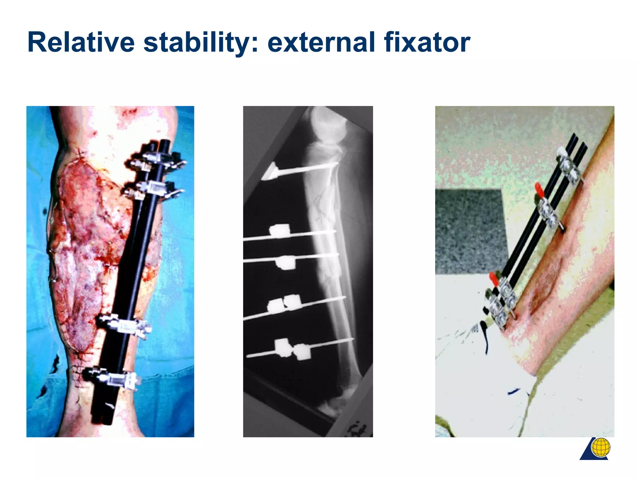 Relative stability: external fixator
 