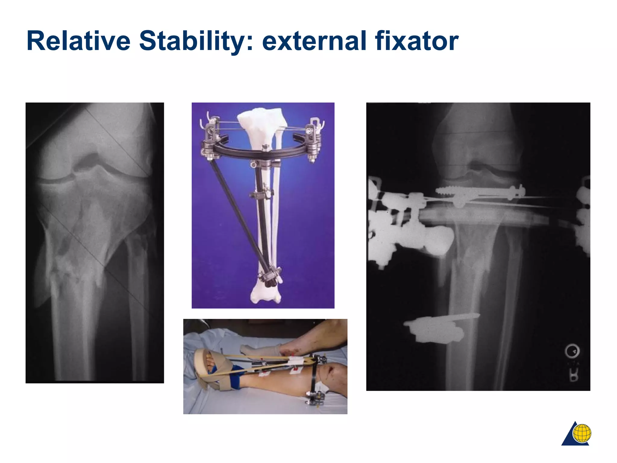 Relative Stability: external fixator
 