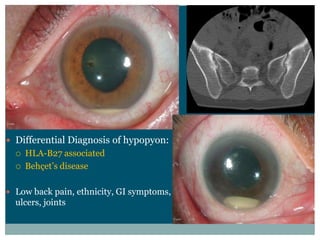 Differential  Diagnosis  of  hypopyon:
  HLA-­B27  associated



Low  back  pain,  ethnicity,  GI  symptoms,  
ulcers,  joints
 