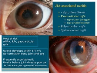 JIA-­associated  uveitis
                                                <16yo,>6mo  disease
                                                Pauci-­articular:  25%
                                                     Type  1=Ana+  young  girls
                                                     Type  2=Older  boys  B27+
                                                Poly-­articular:  ~15%
                                                Systemic  onset:  1-­5%


Most  at  risk:
ANA+,  RF-­,  pauciarticular  
girls

Uveitis  develops  within  5-­7  yrs
No  correlation  betw  joint  and  eye

Frequently  asymptomatic
Uveitis  before  joint  disease  poor  px
BK/PS/cataract/ON  hyperemia/CME  common
 