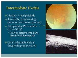 Intermediate  Uveitis

Vitritis  +/-­ periphlebitis
Snowballs,  snowbanking                
(more  severe  disease  process)
Pars  planitis:  PP  exudates            
(HLA-­DR15)
  ~15%  of  patients  with  pars  
  planitis  will  develop  MS

CME  is  the  main  vision  
threatening  complication
 