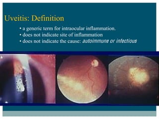 Uveitis: Definition
     a generic term for intraocular inflammation.
     does not indicate site of inflammation
     does not indicate the cause: autoi mmune or infectious
 