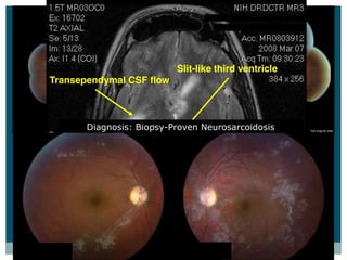 Slit-like third ventricle
      Transependymal CSF flow



               Diagnosis:  Biopsy-­Proven  Neurosarcoidosis




30  yo  AAM:  Referred  for  endogenous  candida  endophthalmitis
Also  has  recent  onset  of  headache,  mood  changes,  gait  abnormalities



                     Enlarged lateral ventricles
 