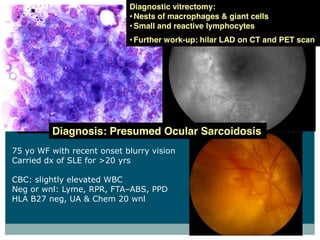 Diagnostic vitrectomy:
                                  Nests of macrophages & giant cells
                                  Small and reactive lymphocytes
                                  Further work-up: hilar LAD on CT and PET scan




           Diagnosis: Presumed Ocular Sarcoidosis
75  yo  WF  with  recent  onset  blurry  vision
Carried  dx  of  SLE  for  >20  yrs

CBC:  slightly  elevated  WBC
Neg  or  wnl:  Lyme,  RPR,  FTA ABS,  PPD  
HLA  B27  neg,  UA  &  Chem  20  wnl
 