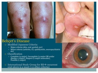 Modified  Japanese  Criteria:
  Major  criteria  (skin,  oral,  genital,  eye)
  Minor  criteria  (arthritis,  GI,  epididymitis,  neuropsychiatric  
  etc)
Classification
  Complete  (4  major),  Incomplete  (3  major  OR  ocular  
  disease+1  major),  Suspect  (2  major  nonocular),                      
  Possible  (1  major)

International  Study  Group  for  BD recurrent  
oral  ulcers  is  a  must  (+2  other  criteria)
 