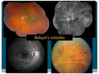 retinitis
 