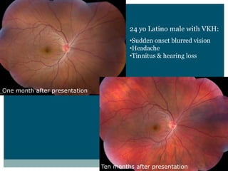 24  yo Latino  male  with  VKH:
                                             Sudden  onset  blurred  vision
                                             Headache
                                             Tinnitus  &  hearing  loss




One  month  after  presentation




                                  Ten  months  after  presentation
 