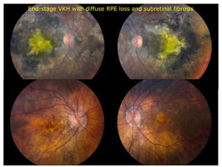 End-­stage  VKH  with  diffuse  RPE  loss  and  subretinal  fibrosis
 