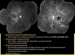 Retinal  Vasculitis




Systemic  Lupus  Erythematosus
  Retinopathy  is  an  important  marker  of  systemic  activity  esp  CNS  vasculitis-­75%
Polyarteritis  Nodosa  (PAN)

 Untreated:  90%  mortality
Wegener  granulomatosis  
 Necrotizing  granulomatosis  of  upper  &  lower  resp  tract  -­esp  paranasal  sinuses
 Glomerulonephritis  (85%),  peripheral  neuropathy  
 Untreated:  80%  mortality
 