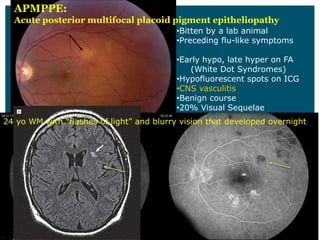 APMPPE:  
Acute  posterior  multifocal  placoid  pigment  epitheliopathy
                                      Bitten  by  a  lab  animal
                                      Preceding  flu-­like  symptoms

                                      Early  hypo,  late  hyper  on  FA
                                        (White  Dot  Syndromes)
                                      Hypofluorescent  spots  on  ICG
                                      CNS  vasculitis
                                      Benign  course
                                      20%  Visual  Sequelae
 
