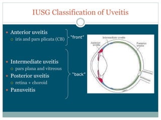 IUSG  Classification  of  Uveitis

Anterior  uveitis
  iris  and  pars  plicata  (CB)




Intermediate  uveitis
  pars  plana  and  vitreous
Posterior  uveitis
  retina  +  choroid
Panuveitis
 