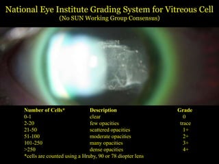 National  Eye  Institute  Grading  System  for  Vitreous  Cell
                        (No  SUN  Working  Group  Consensus)




     Number  of  Cells*                 Description                      Grade
     0-­1                               clear                               0
     2-­20                              few  opacities                    trace
     21-­50                             scattered  opacities                1+
     51-­100                            moderate  opacities                 2+
     101-­250                           many  opacities                     3+
     >250                               dense  opacities                    4+
     *cells  are  counted  using  a  Hruby,  90  or  78  diopter  lens
 