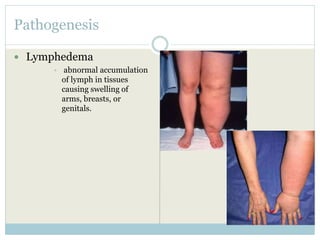 Pathogenesis
 Lymphedema
• abnormal accumulation
of lymph in tissues
causing swelling of
arms, breasts, or
genitals.
 