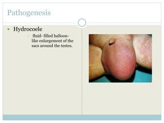 Pathogenesis
 Hydrocoele
• fluid- filled balloon-
like enlargement of the
sacs around the testes.
 