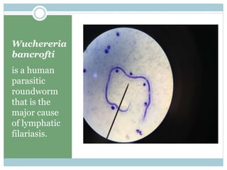 Wuchereria
bancrofti
is a human
parasitic
roundworm
that is the
major cause
of lymphatic
filariasis.
 
