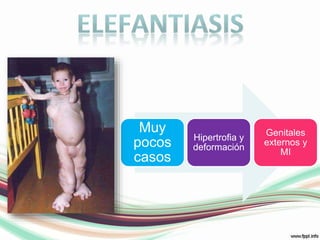 elefantiasis