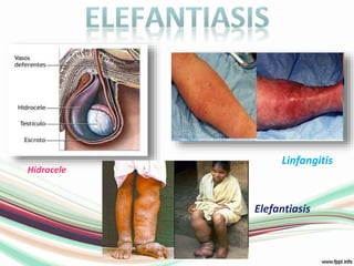 elefantiasisLinfangitisHidrocele Elefantiasis